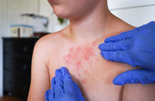 Managing Lichen Planus: Symptoms, Causes, and Fast-Acting Relief