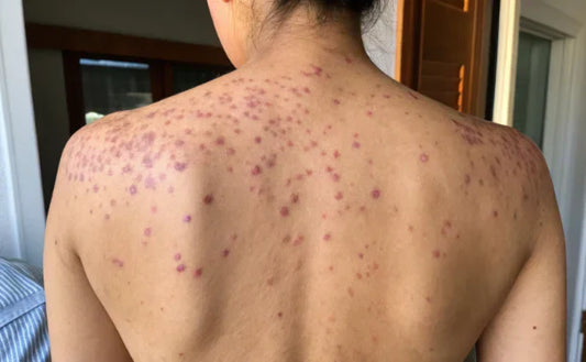 What is Lichen Planus & How Do I Find Relief at Home?