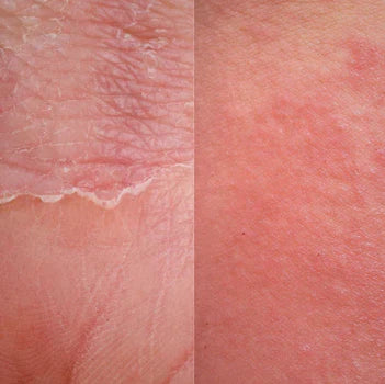What’s The Difference Between Eczema and Psoriasis?