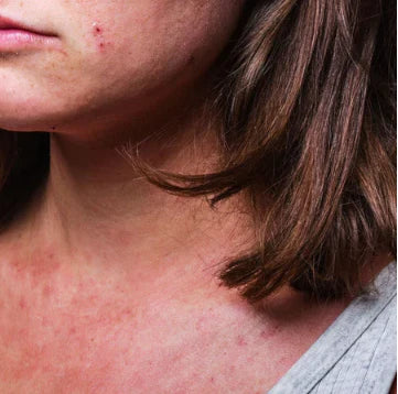 Eczema Flare Ups – How to Manage, Treat and Prevent Them