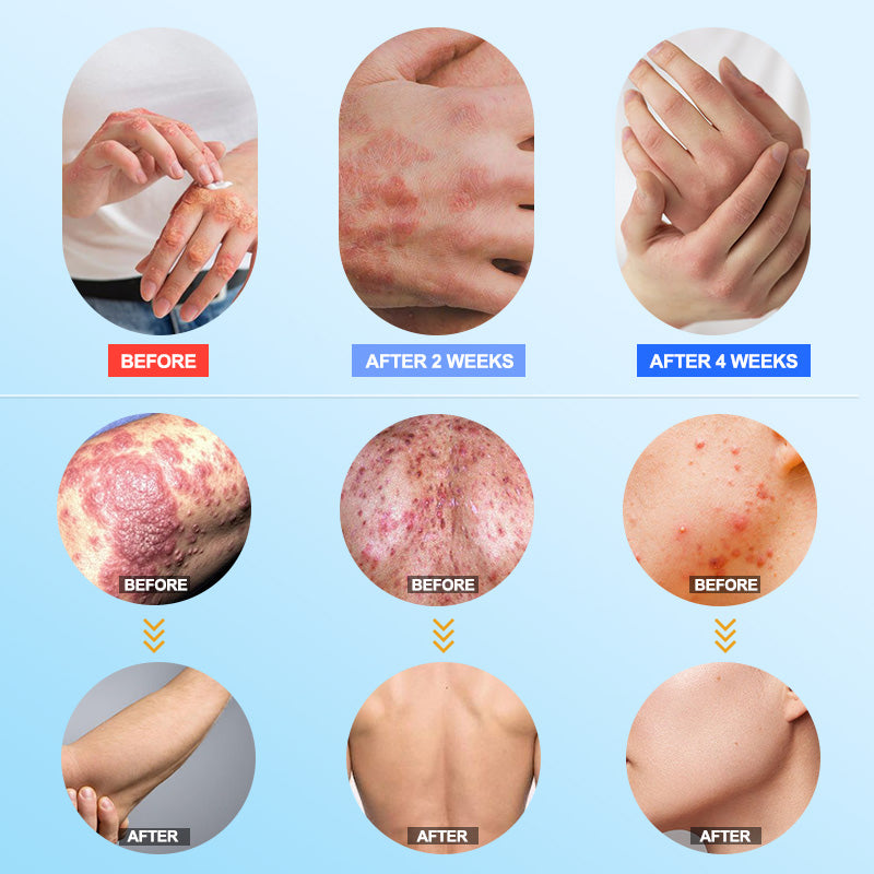 👉 Official Store: Dermynex®️ PCA-Magnesium Herbal Intimate – Multi‑Purpose Relief for Scalp Itching, Eczema, Jock Itch, Facial Acne & Fungal Infections | Herbal Extracts, Steroid‑Free, No Artificial Fragrances, Gentle for All Skin Types【Tax Free】