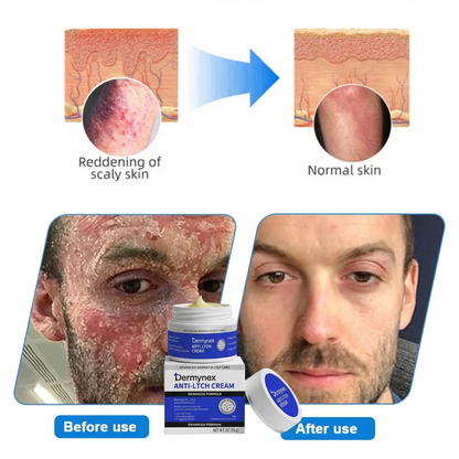 👉 Official Store: Dermynex®️ PCA-Magnesium Herbal Intimate – Multi‑Purpose Relief for Scalp Itching, Eczema, Jock Itch, Facial Acne & Fungal Infections | Herbal Extracts, Steroid‑Free, No Artificial Fragrances, Gentle for All Skin Types【Tax Free】